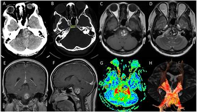 Endoscopic Endonasal Transclival Approach to Ventral Pontine Cavernous Malformation: Case Report